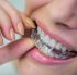 How Much Do Aligners Cost