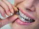 How Much Do Aligners Cost
